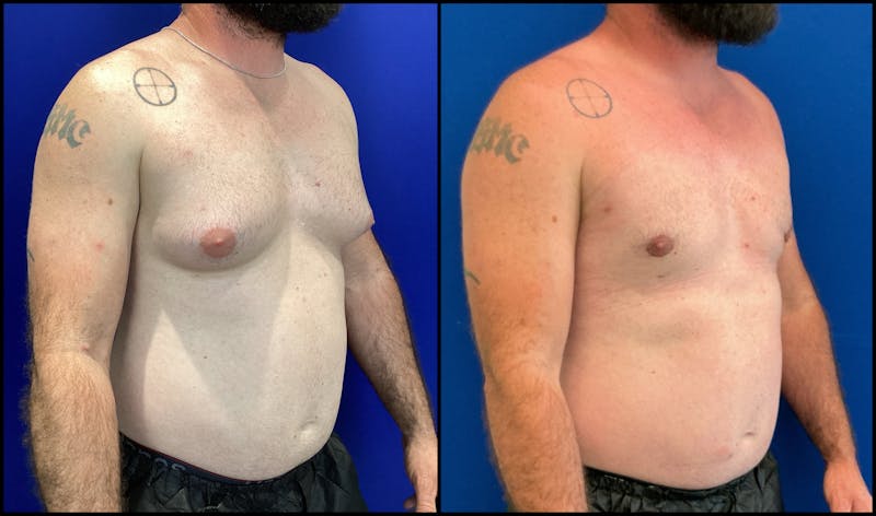 Patient JvBomcPMTgWEbrvA6JymTA - Gynecomastia Before & After Photos