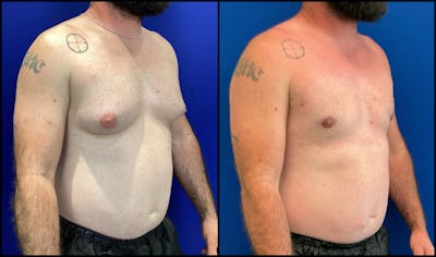 Gynecomastia Before & After Gallery - Patient 158713 - Image 1