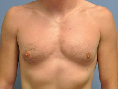 Gynecomastia Before & After Gallery - Patient 428102 - Image 1