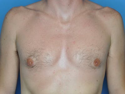 Gynecomastia Before & After Gallery - Patient 428102 - Image 2