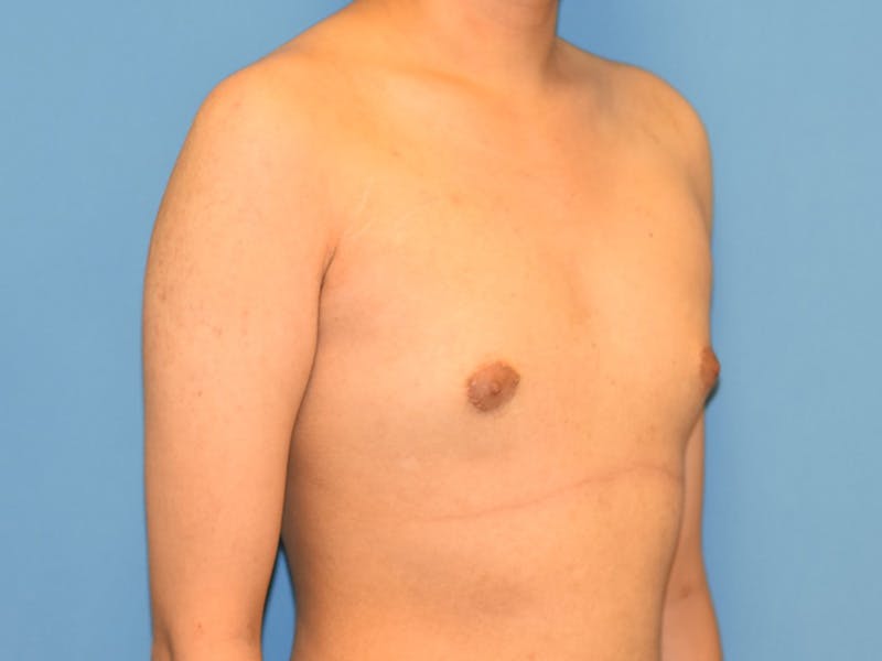 Patient V1yTY8RHRvOSD9L7Kz6ufQ - Gynecomastia Before & After Photos