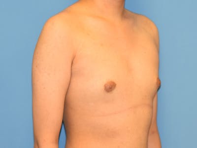 Gynecomastia Before & After Gallery - Patient 221733 - Image 1
