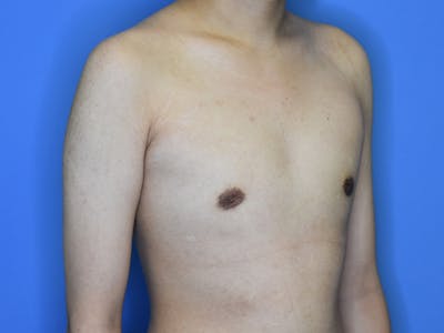 Gynecomastia Before & After Gallery - Patient 221733 - Image 2