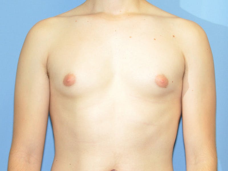 Patient cFcUsyltRNiNoluaPR733g - Gynecomastia Before & After Photos