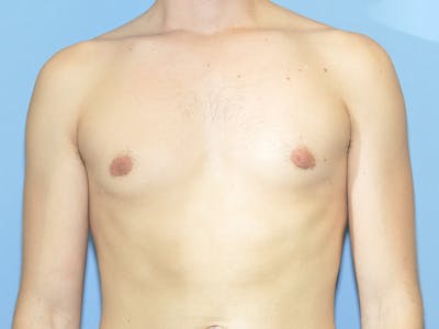 Gynecomastia Before & After Gallery - Patient 329976 - Image 2