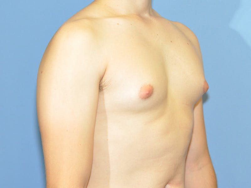 Gynecomastia Before & After Gallery - Patient 329976 - Image 3