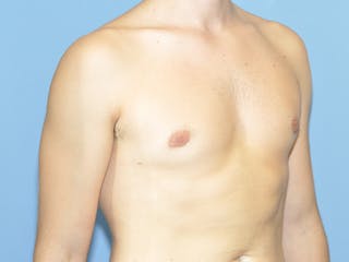 Gynecomastia Before & After Gallery - Patient 329976 - Image 4