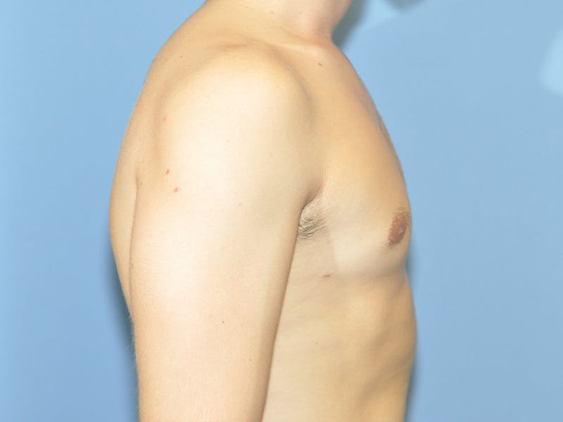 Gynecomastia Before & After Gallery - Patient 329976 - Image 6