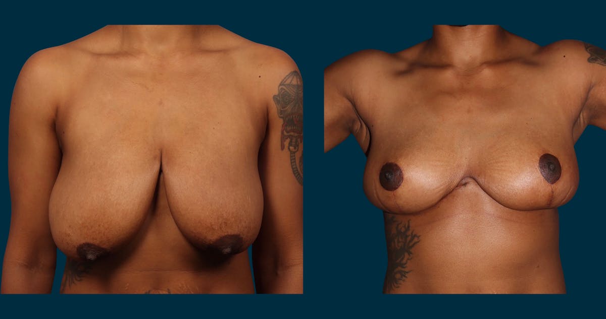 Breast Lift Before & After Gallery - Patient 179587 - Image 1