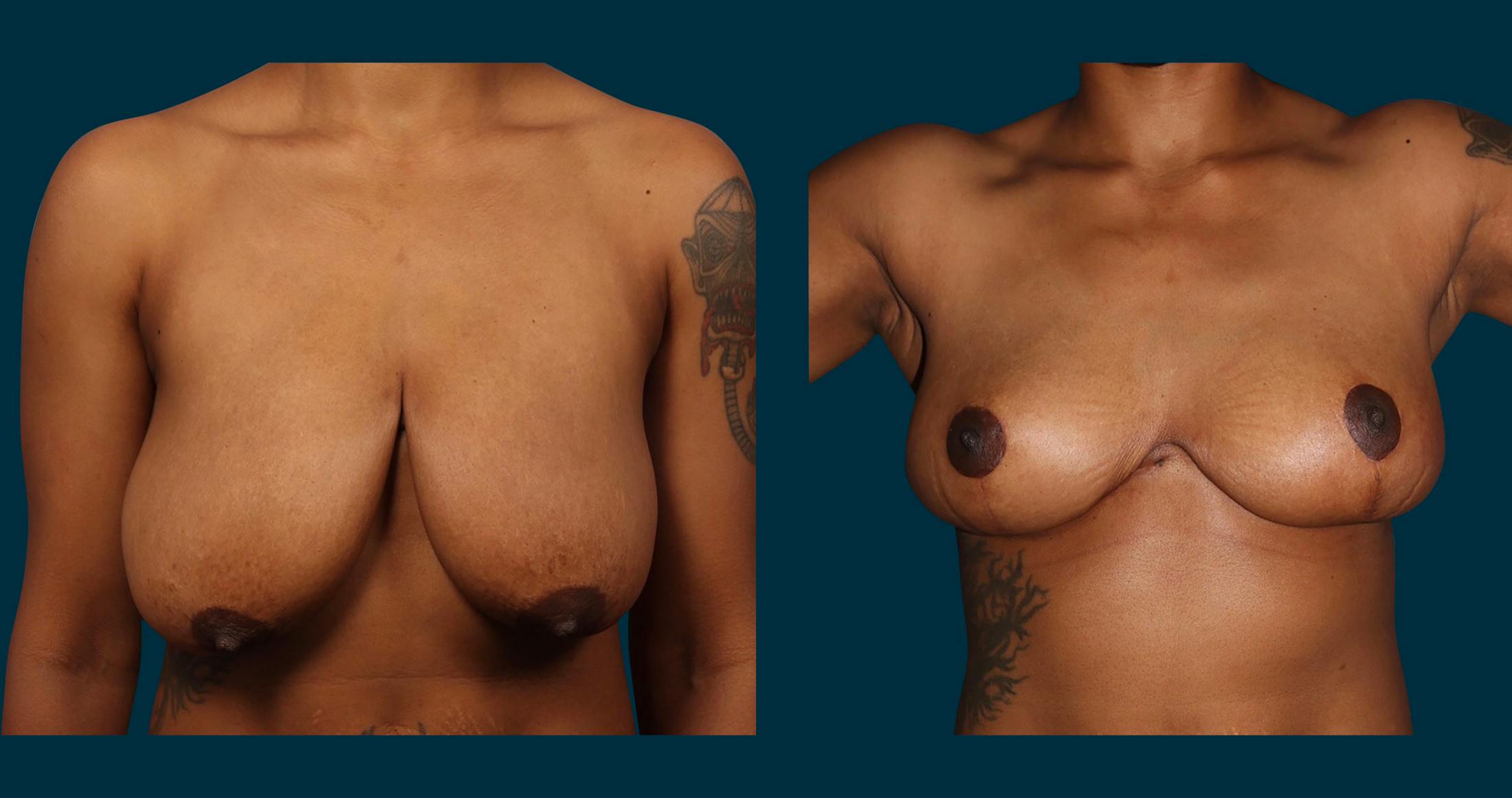 Breast Lift Before & After Gallery - Patient 179587 - Image 1