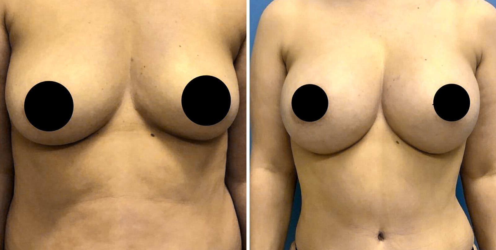 Liposuction Before & After Gallery - Patient 349374 - Image 4