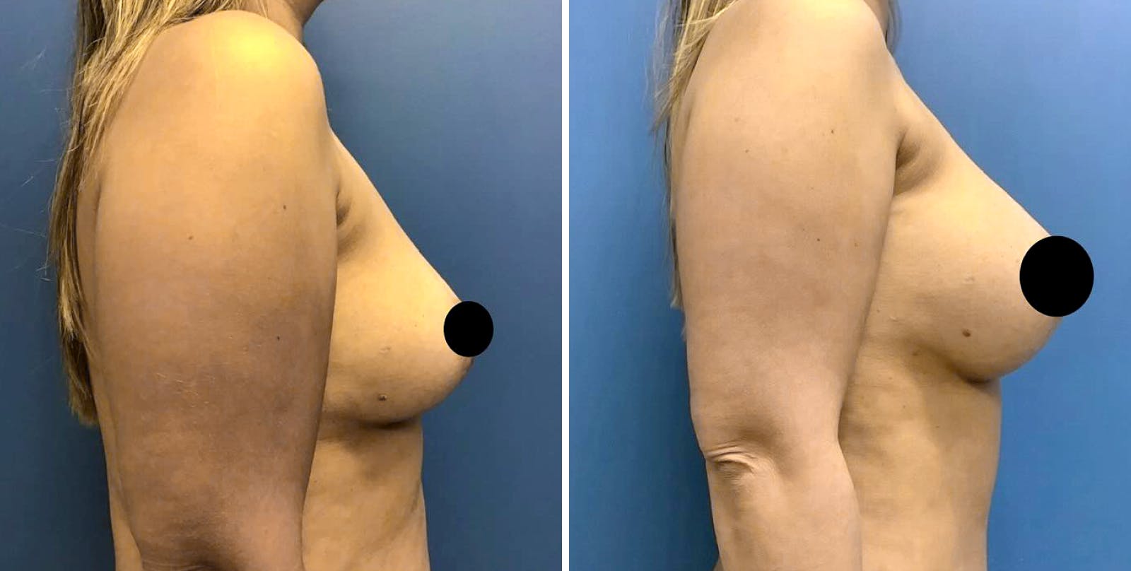 Liposuction Before & After Gallery - Patient 349374 - Image 3