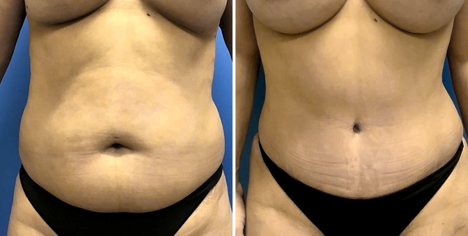 Liposuction Before & After Gallery - Patient 349374 - Image 2