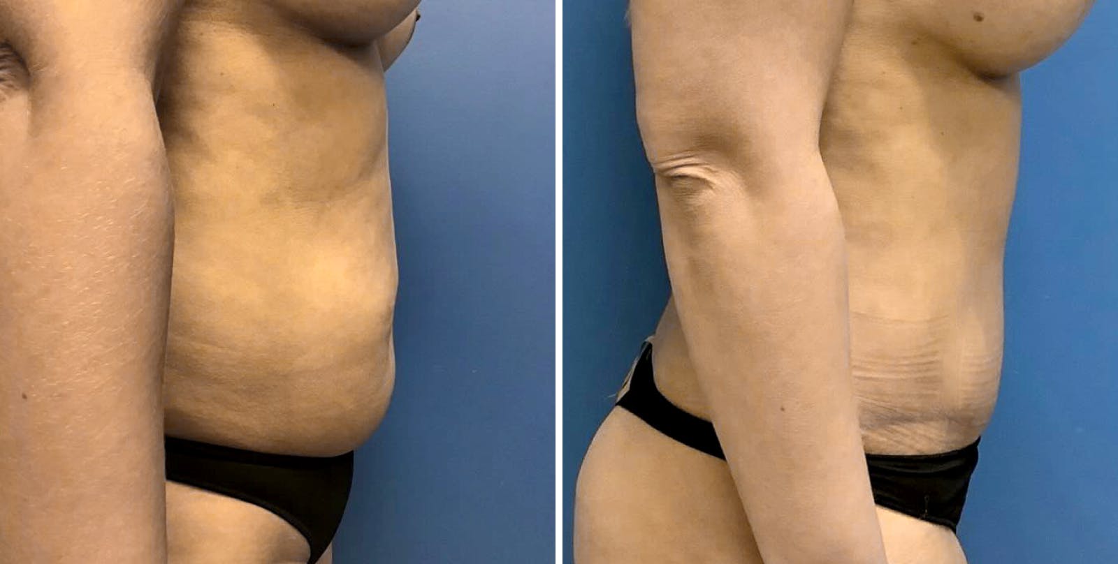 Liposuction Before & After Gallery - Patient 349374 - Image 1