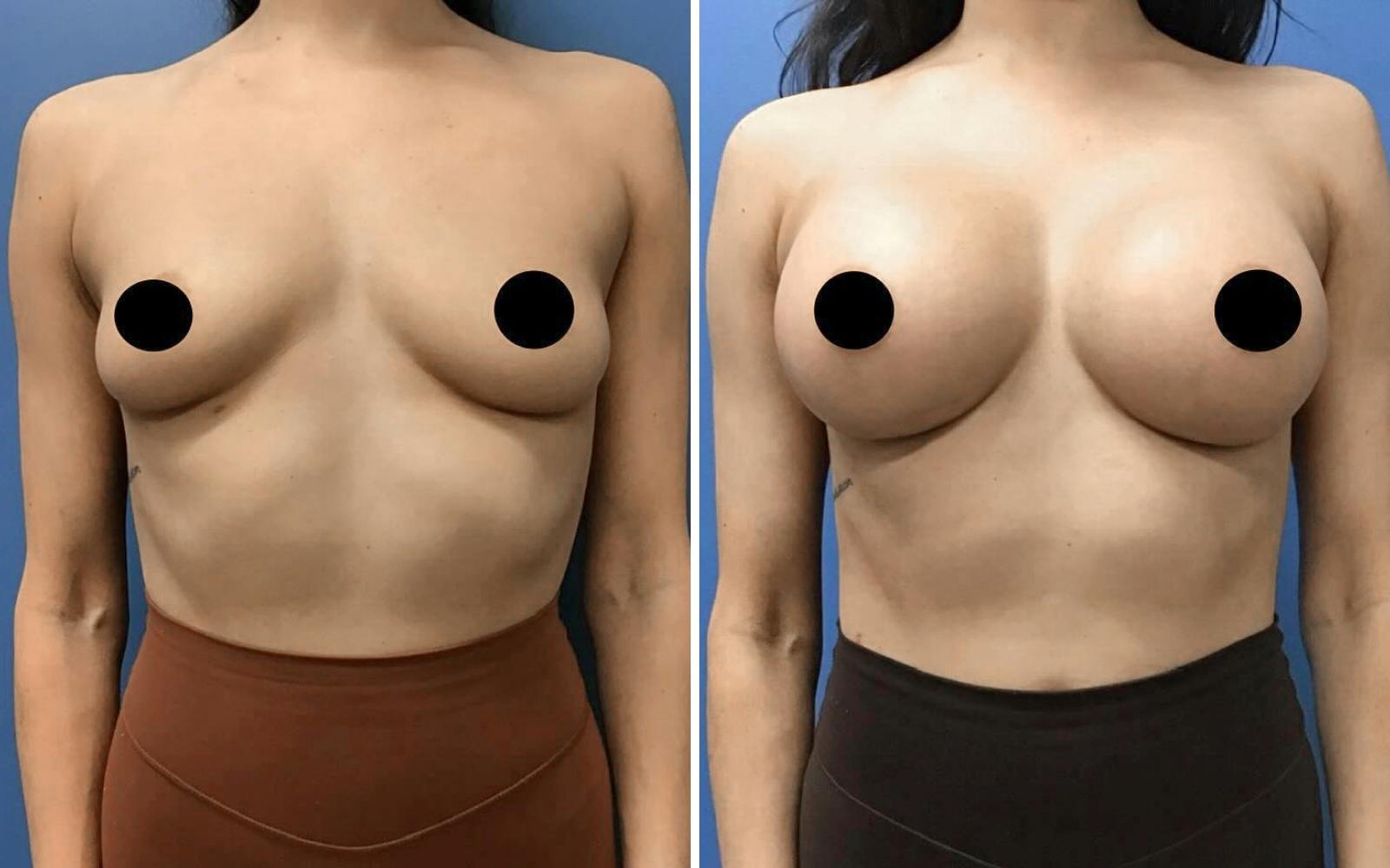 Breast Augmentation Before & After Gallery - Patient 235990 - Image 1