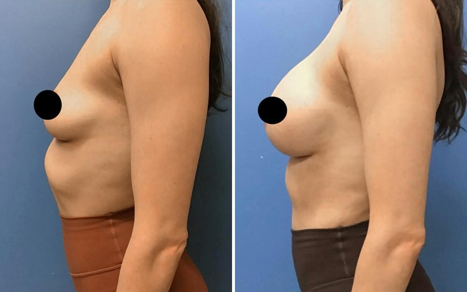 Breast Augmentation Before & After Gallery - Patient 235990 - Image 2