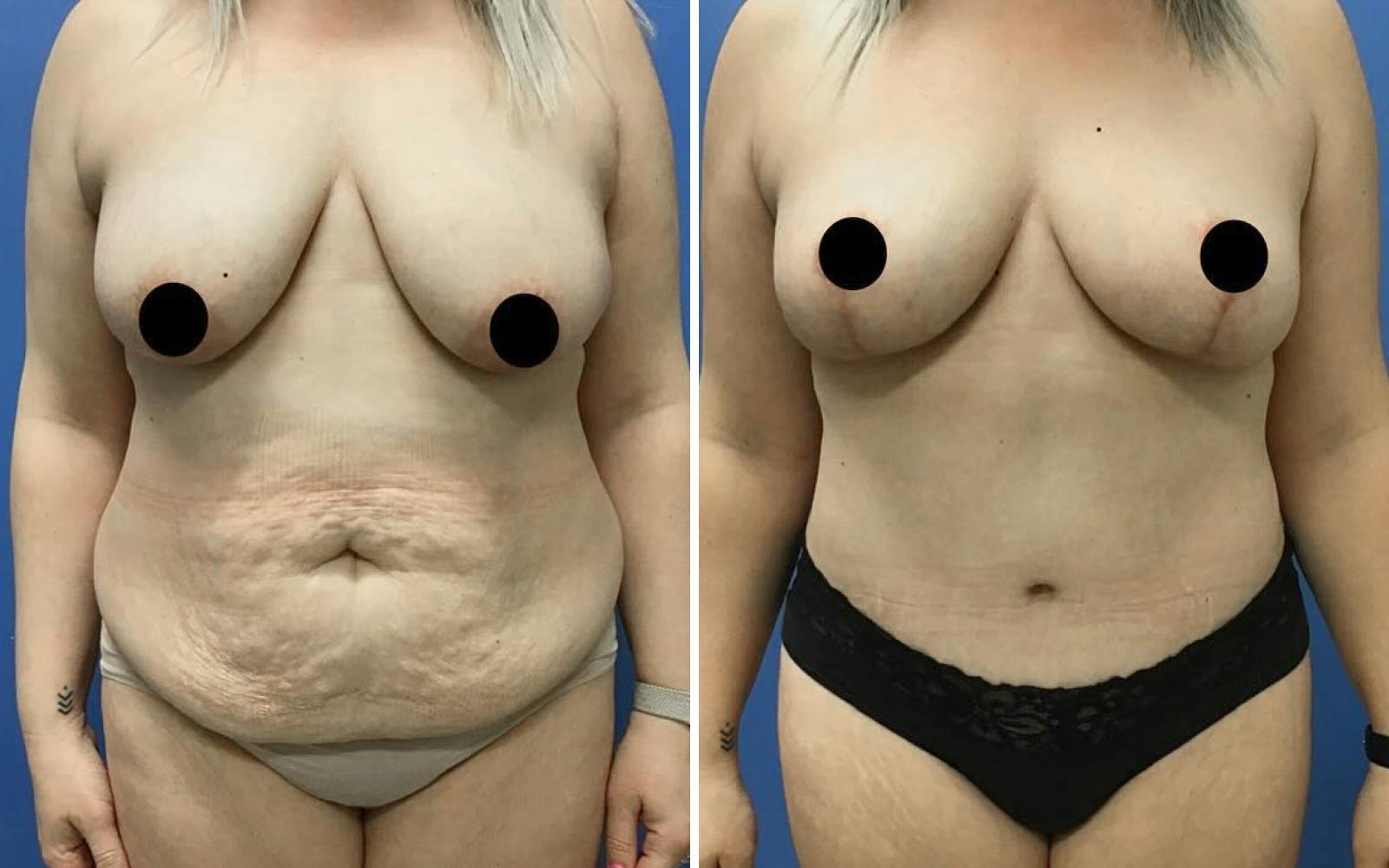 Breast Lift Before & After Gallery - Patient 177720 - Image 2