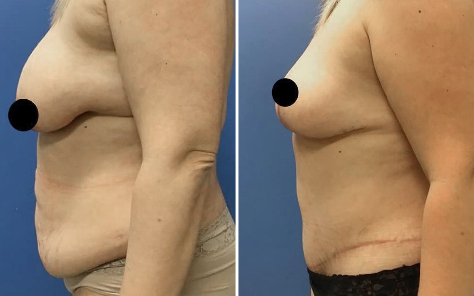Breast Lift patient before & after media