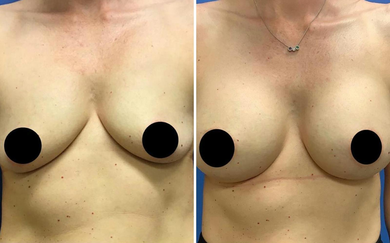 Breast Augmentation Before & After Gallery - Patient 209980 - Image 1