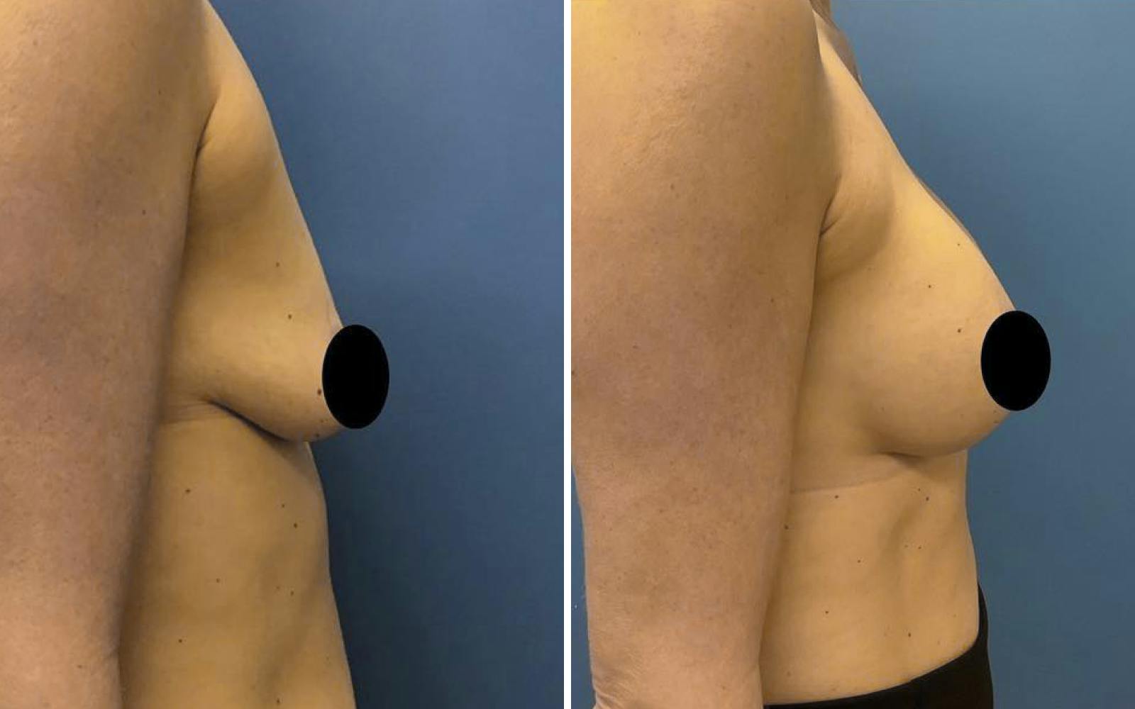 Breast Augmentation Before & After Gallery - Patient 209980 - Image 2