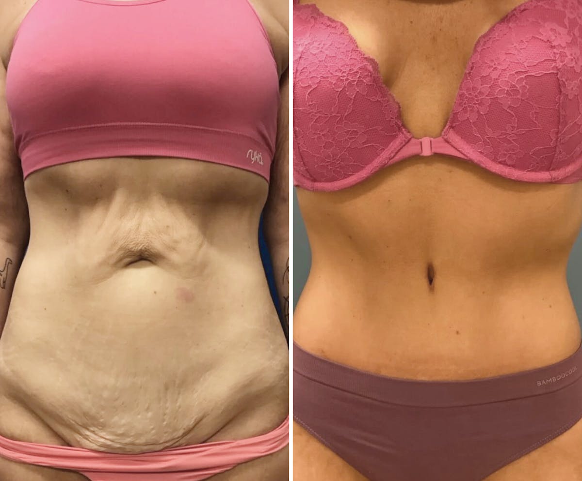 Abdominoplasty Before & After Gallery - Patient 991036 - Image 1