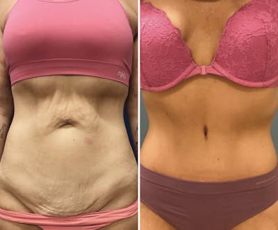 Abdominoplasty Before & After Gallery - Patient 991036 - Image 1