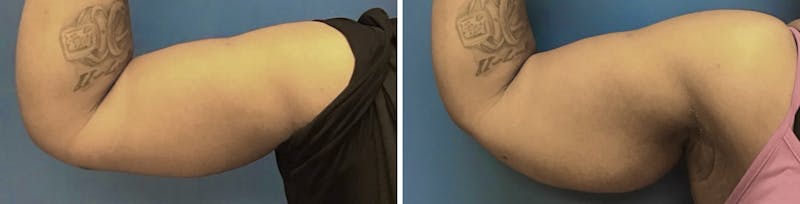 Patient W2pvOgWYQXif9yrt1Bn6RQ - Brachioplasty Before & After Photos