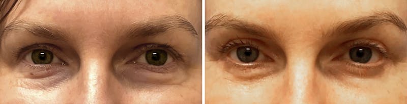 Patient L9li0BMeQlCvOwJ7EWOw3g - Blepharoplasty Before & After Photos