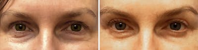 Blepharoplasty Before & After Gallery - Patient 896606 - Image 1