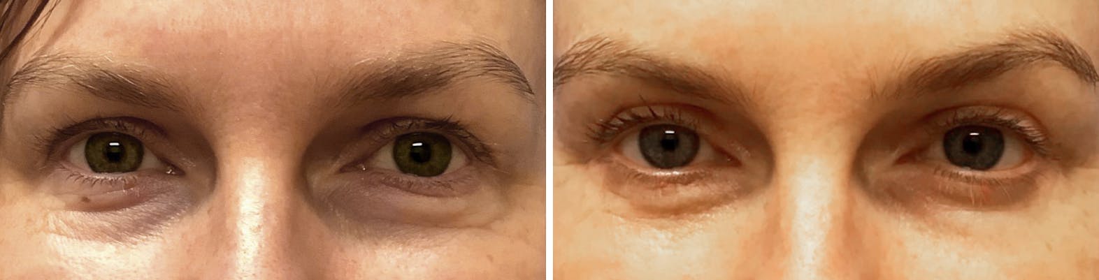 Blepharoplasty Before & after photo