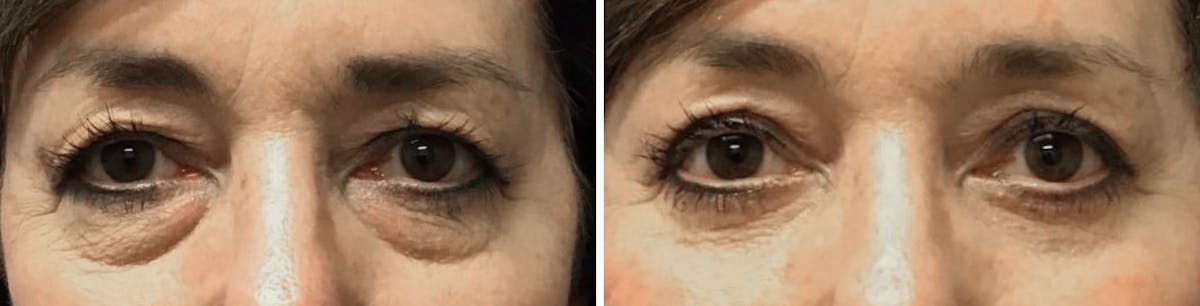 Blepharoplasty Before & After Gallery - Patient 495460 - Image 1