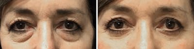 Blepharoplasty Before & After Gallery - Patient 495460 - Image 1