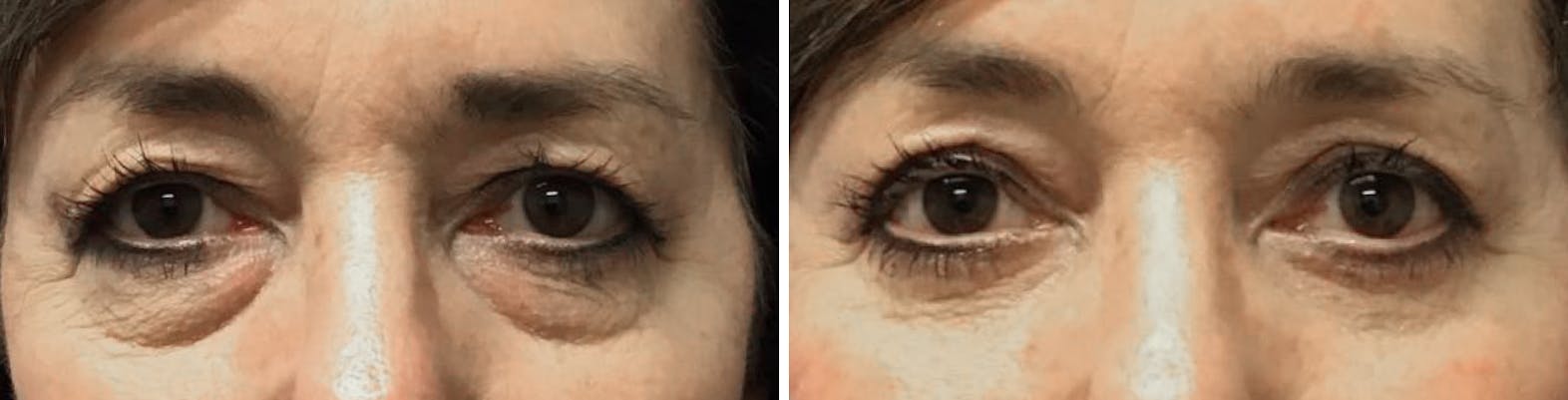 Blepharoplasty patient before & after media