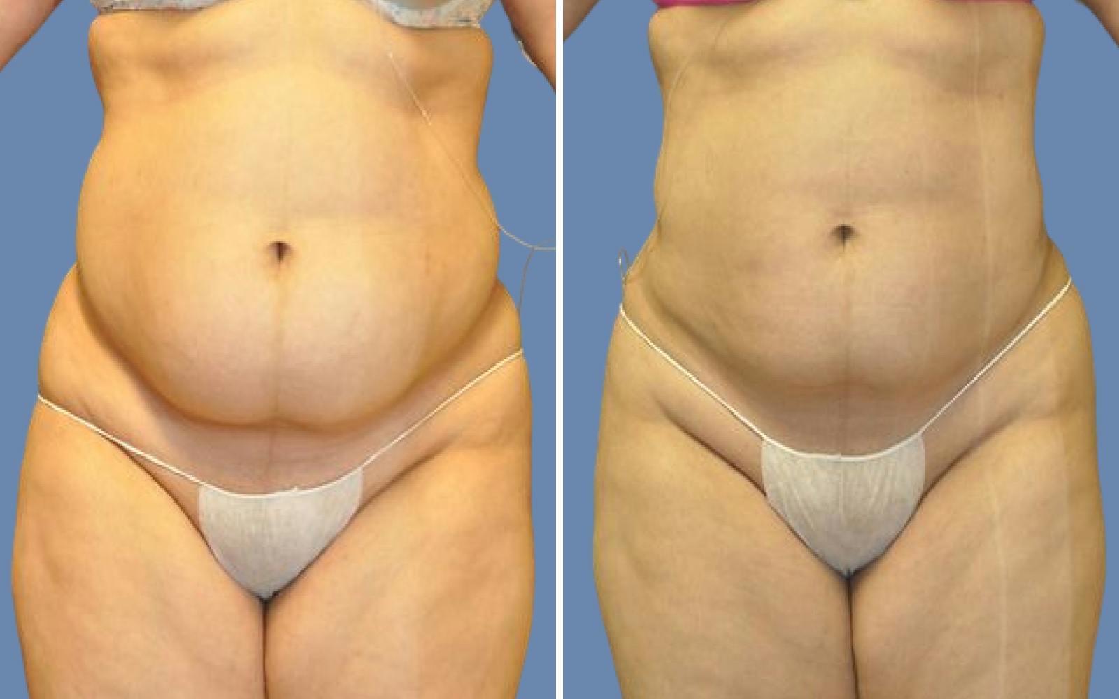 Liposuction Before & After Gallery - Patient 251532 - Image 1