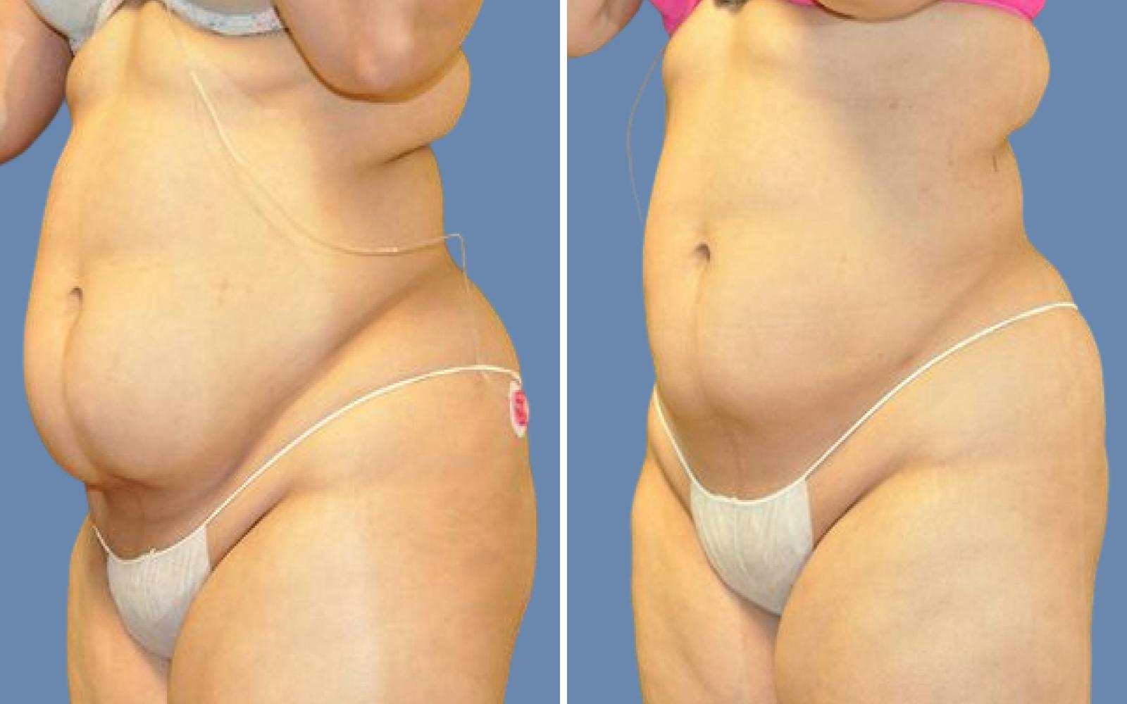 Liposuction Before & After Gallery - Patient 251532 - Image 2