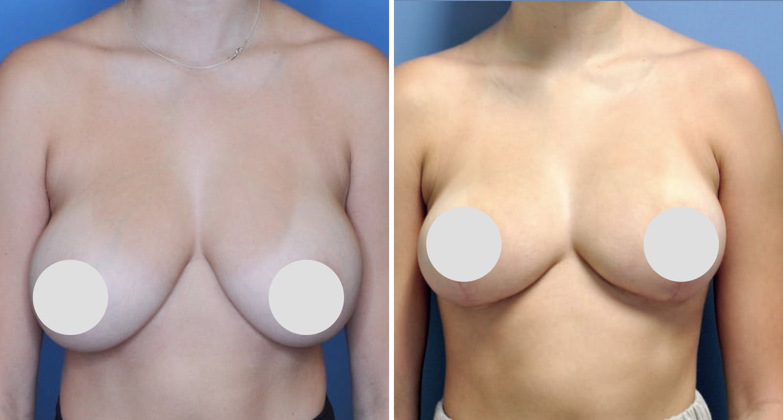 Breast Reduction Before & After Gallery - Patient 259506 - Image 1