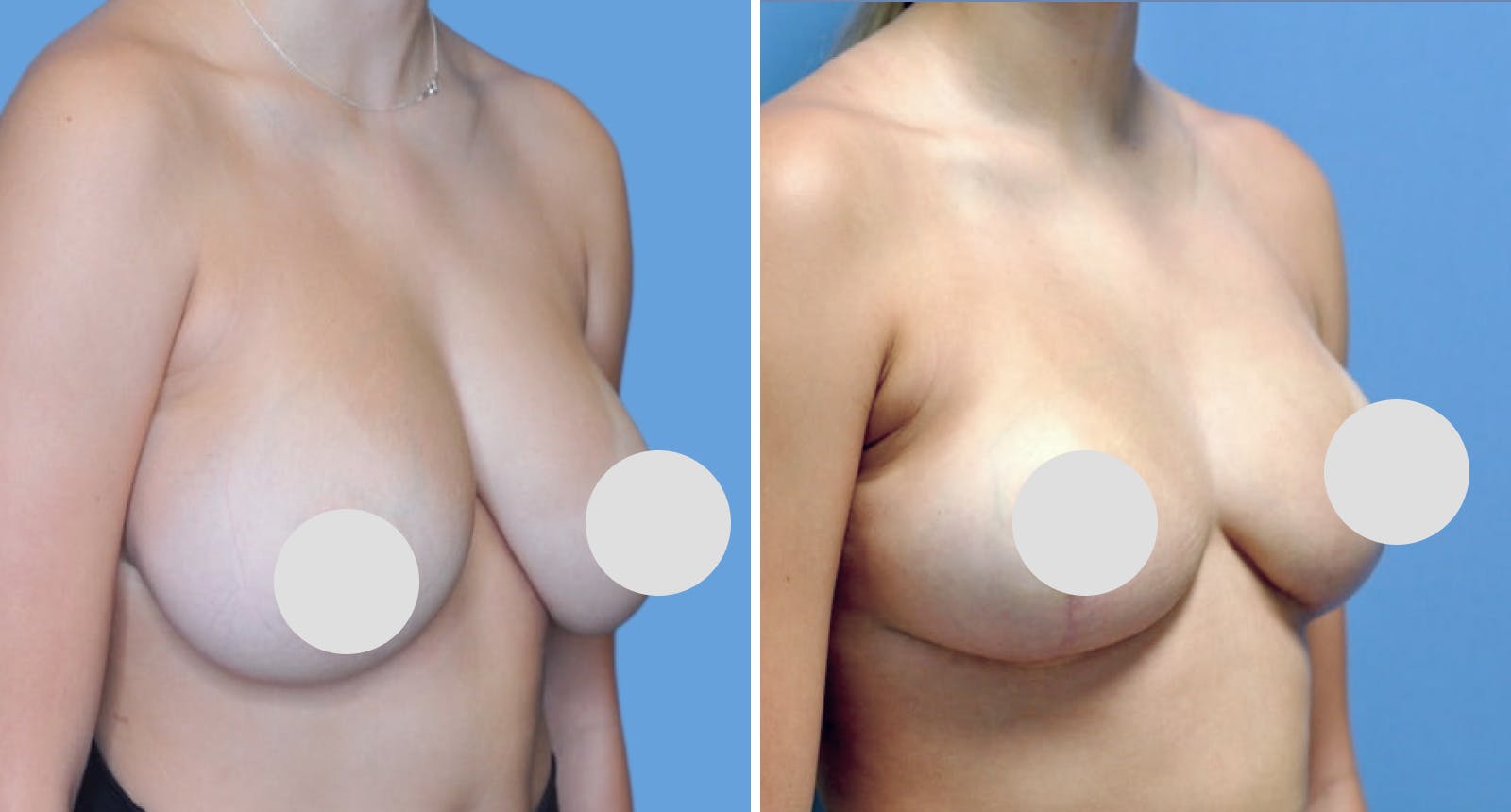 Breast Reduction Before & After Gallery - Patient 259506 - Image 2