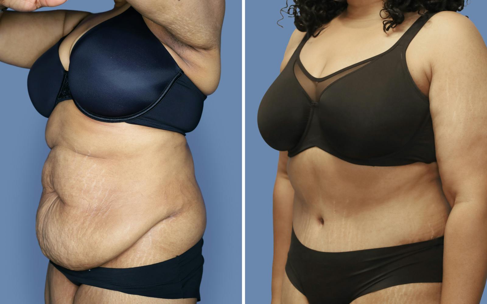 Abdominoplasty Before & After Gallery - Patient 228650 - Image 2