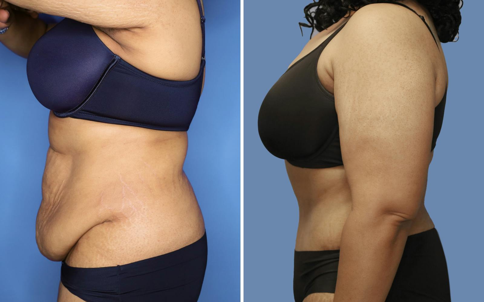 Abdominoplasty Before & After Gallery - Patient 228650 - Image 3