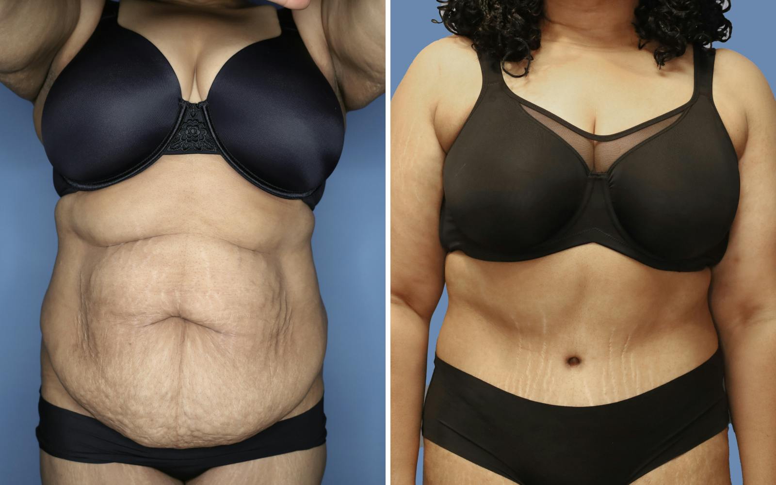 Abdominoplasty Before & After Gallery - Patient 228650 - Image 1