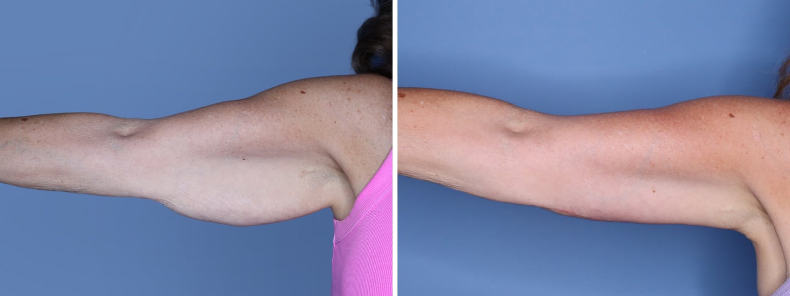 Brachioplasty Before & After Gallery - Patient 222111 - Image 2
