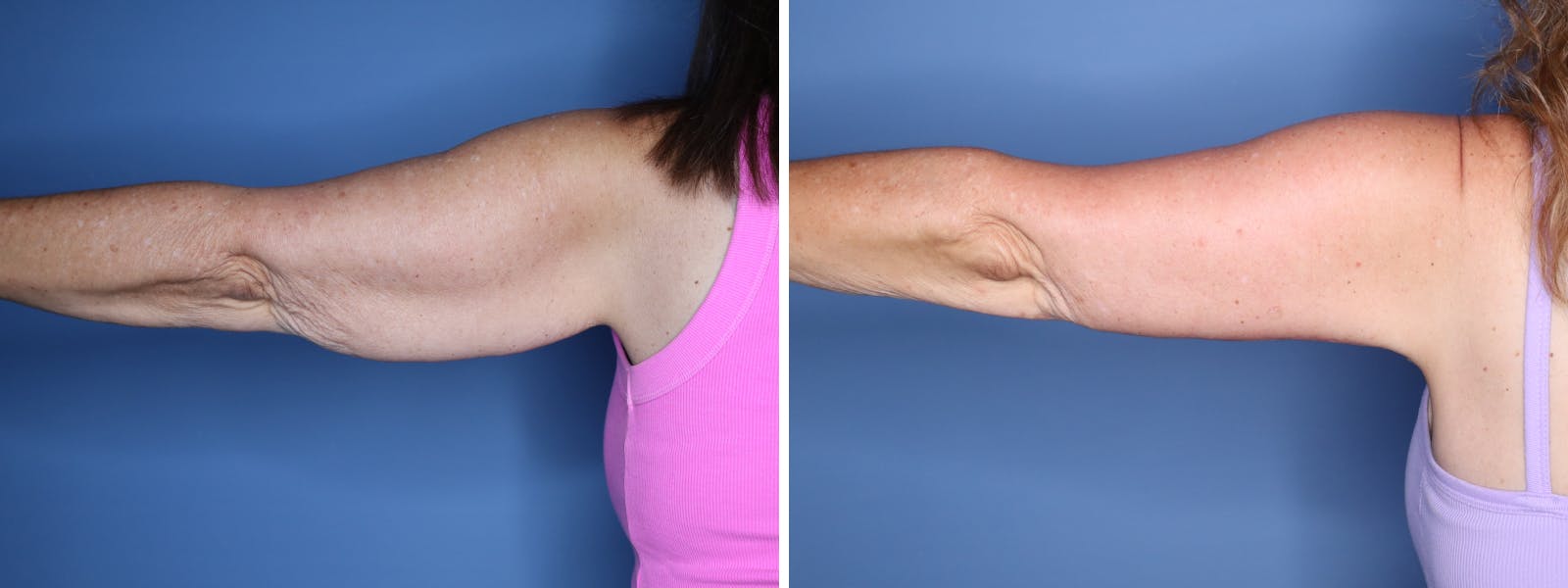 Brachioplasty Before & After Gallery - Patient 222111 - Image 1