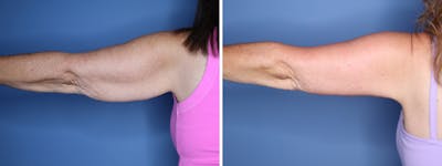 Brachioplasty Before & After Gallery - Patient 222111 - Image 1
