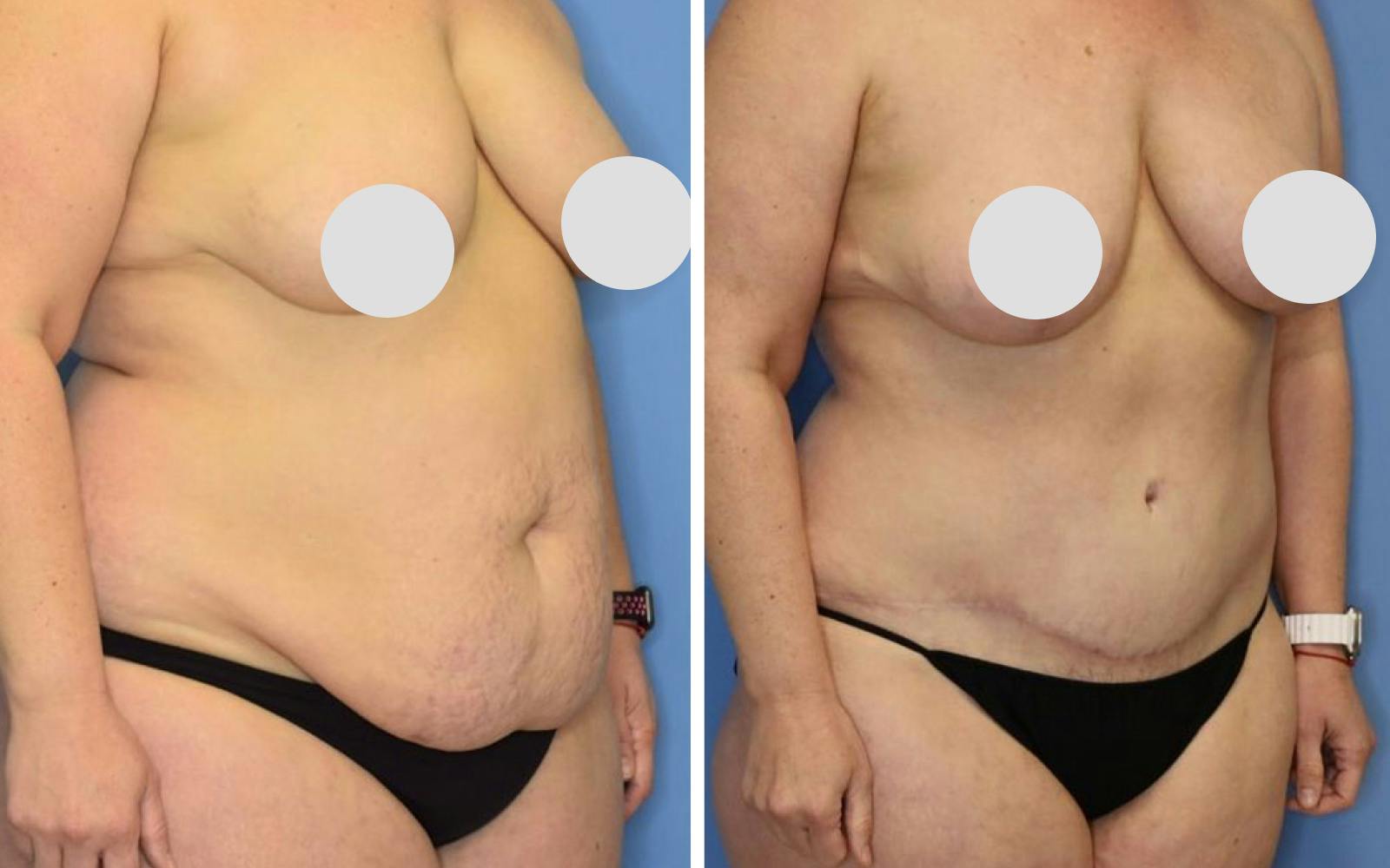 Mommy Makeover Before & After Gallery - Patient 252930 - Image 1