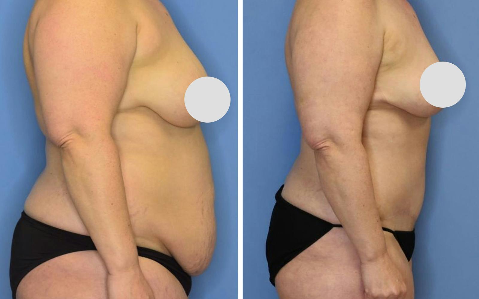 Mommy Makeover Before & After Gallery - Patient 252930 - Image 2