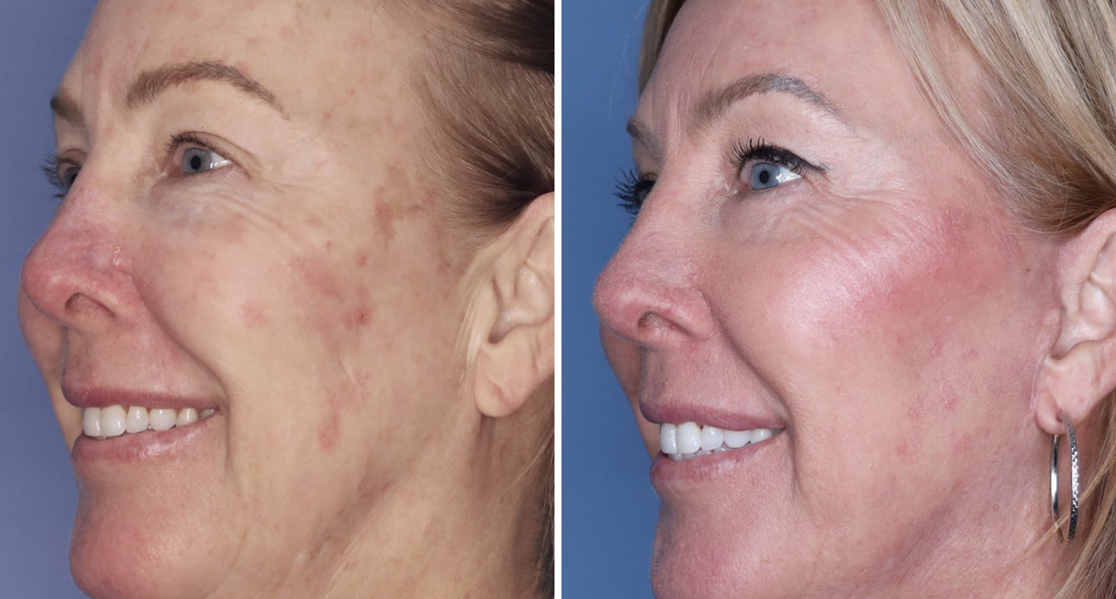 Facelift Before & After Gallery - Patient 222886 - Image 3