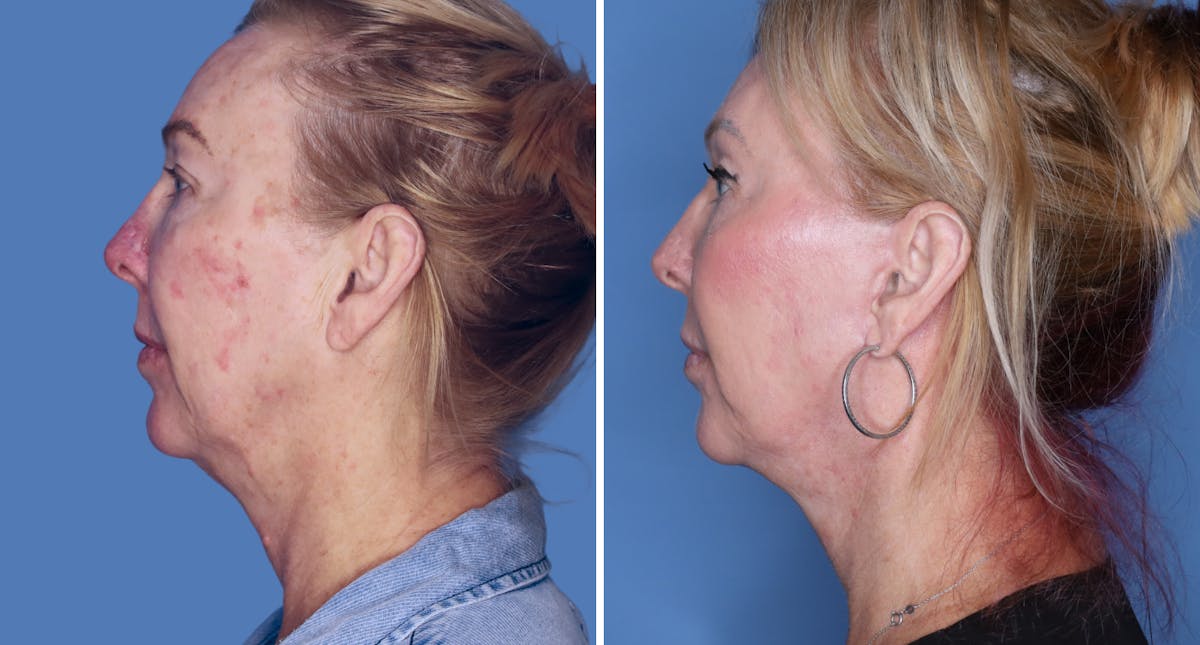 Facelift Before & After Gallery - Patient 222886 - Image 2