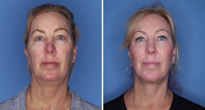 Facelift Before & After Gallery - Patient 222886 - Image 1