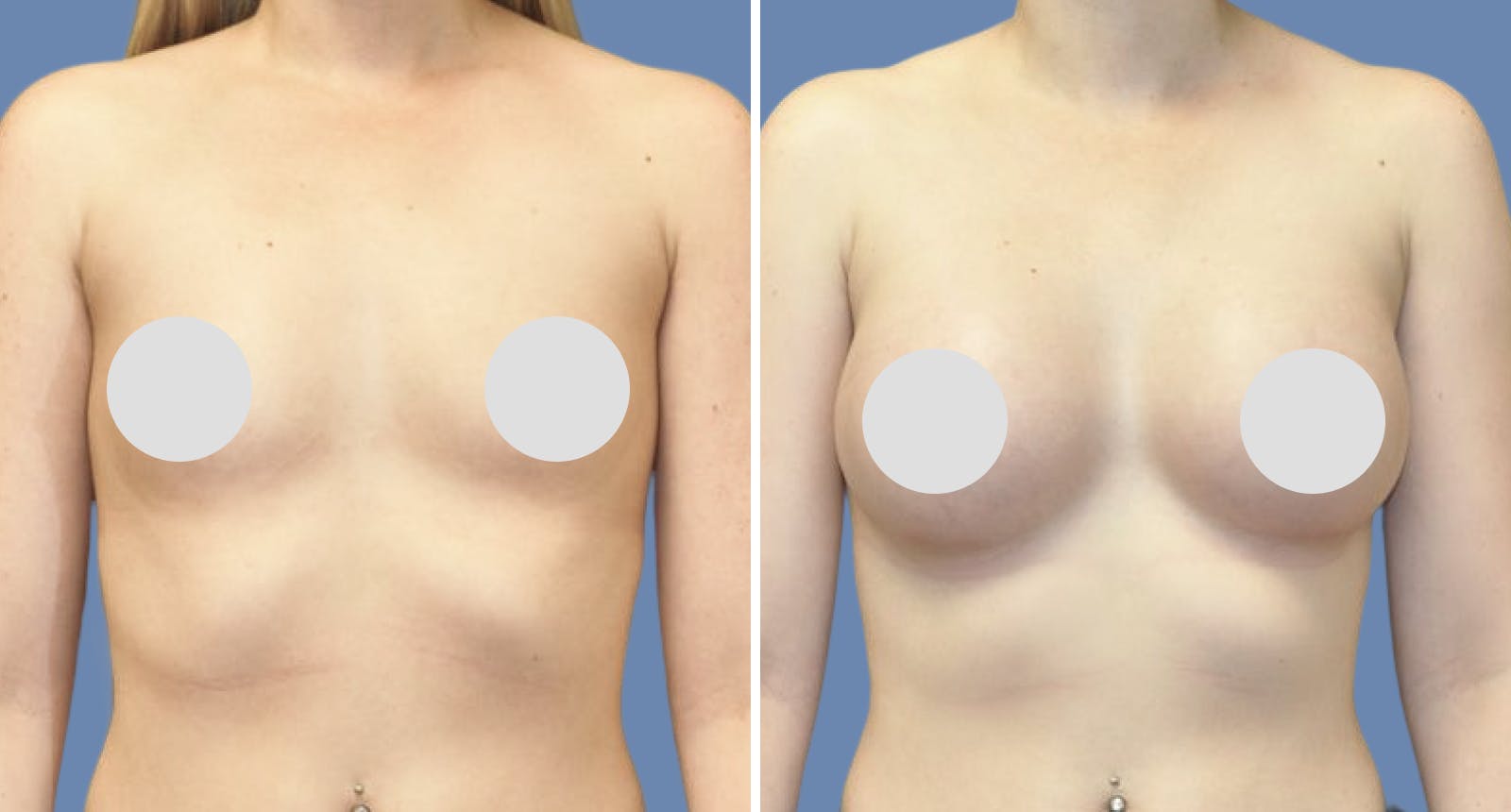 Breast Augmentation Before & After Gallery - Patient 181950 - Image 1
