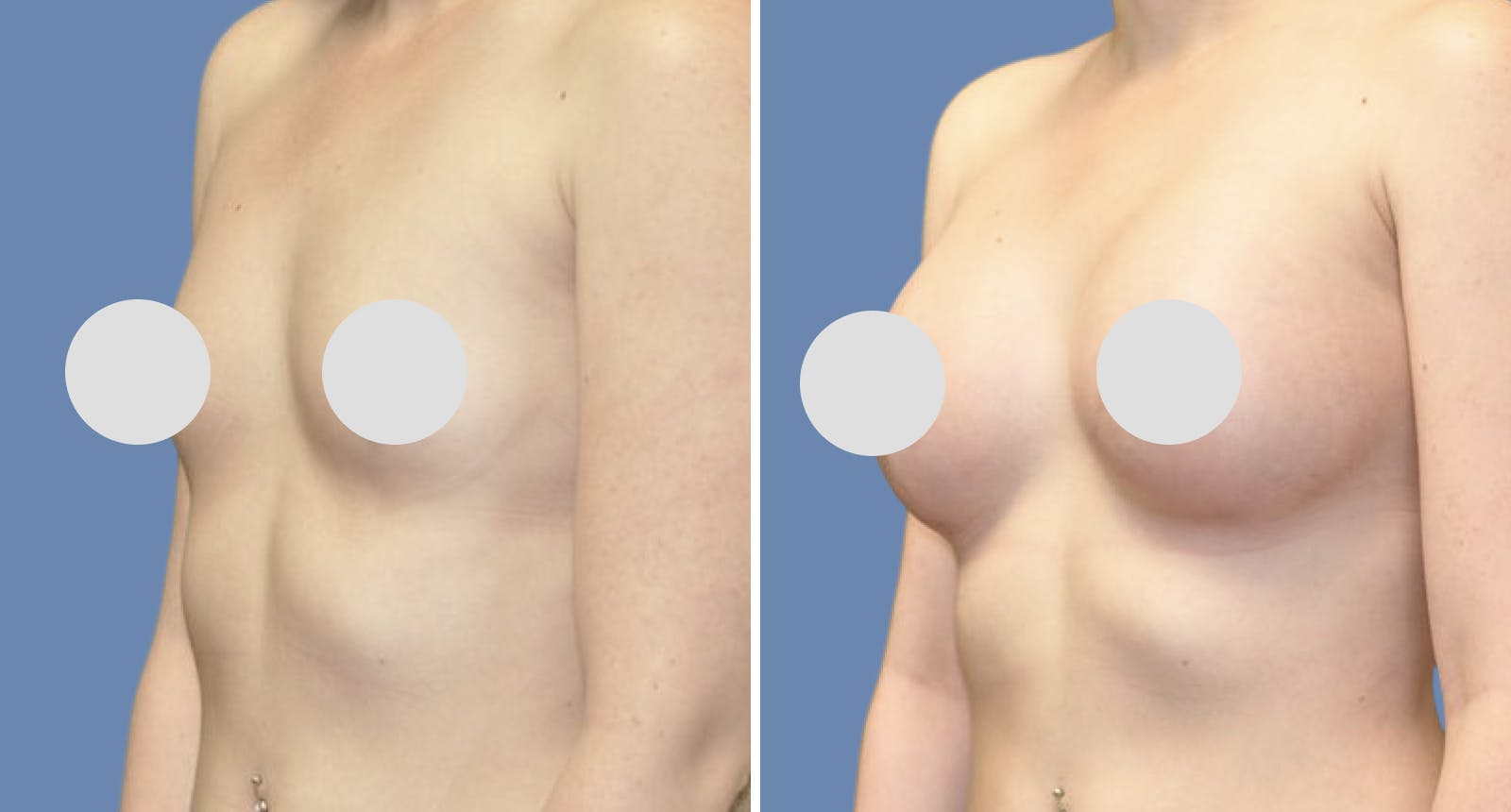 Breast Augmentation Before & After Gallery - Patient 181950 - Image 2